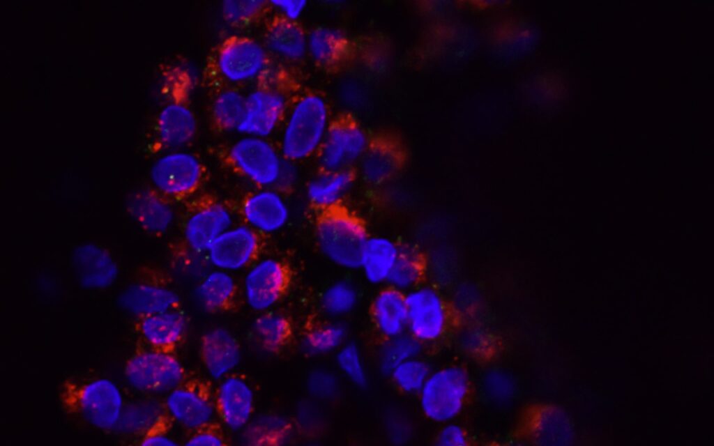 Circulating breast cancer cells visualized under microscopy