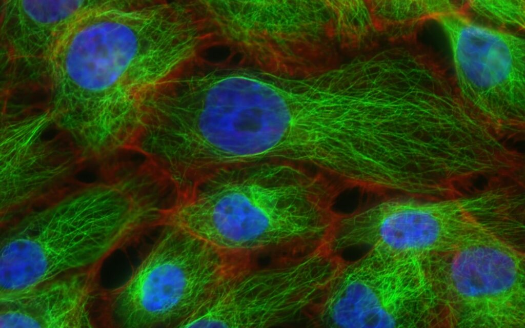 Fluorescence microscopy image of human breast cancer cells