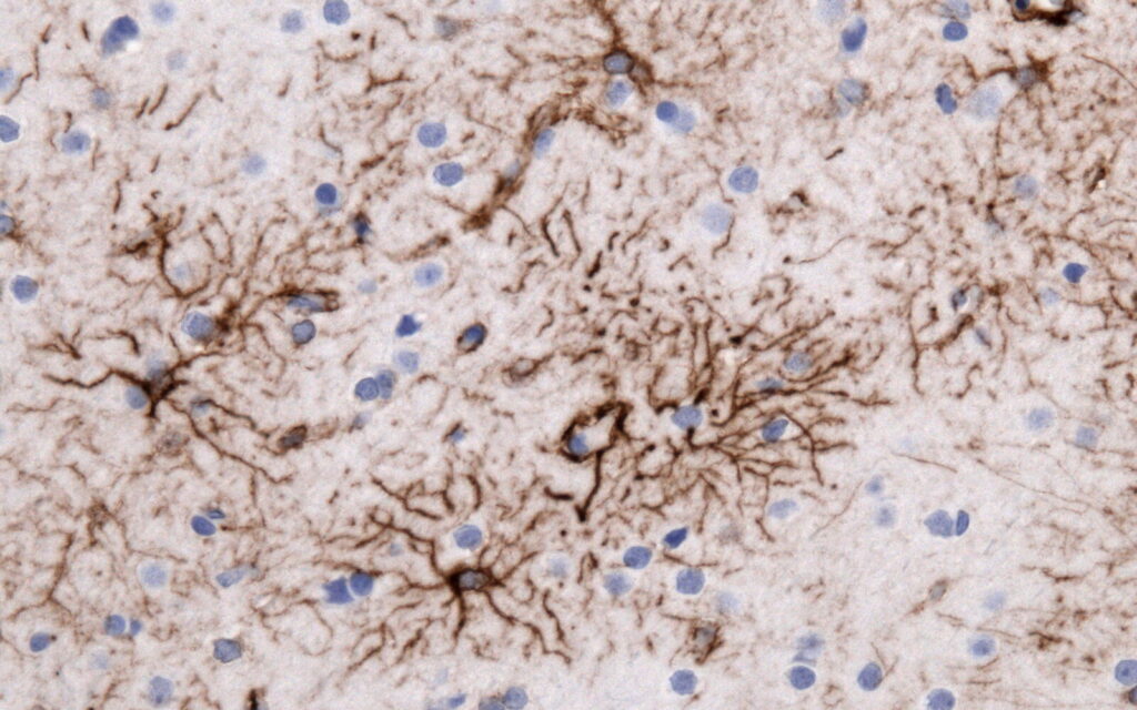 GFAP mutations in Alexander disease: how they damage astrocytes