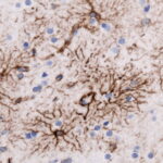 GFAP mutations in Alexander disease: how they damage astrocytes