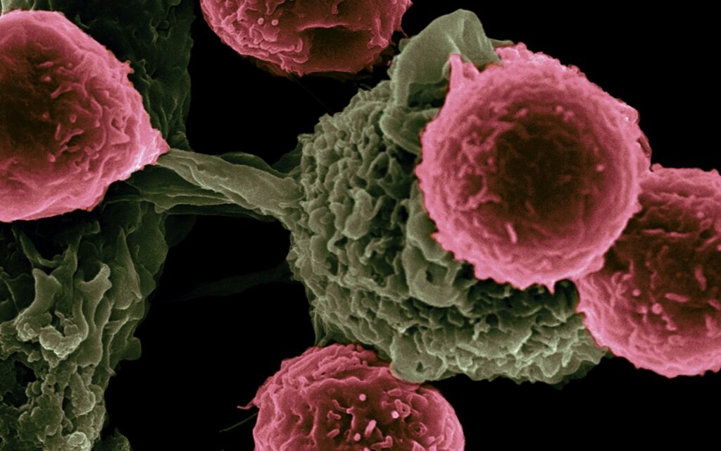 KRAS in pancreatic cancer: why it is so hard to target