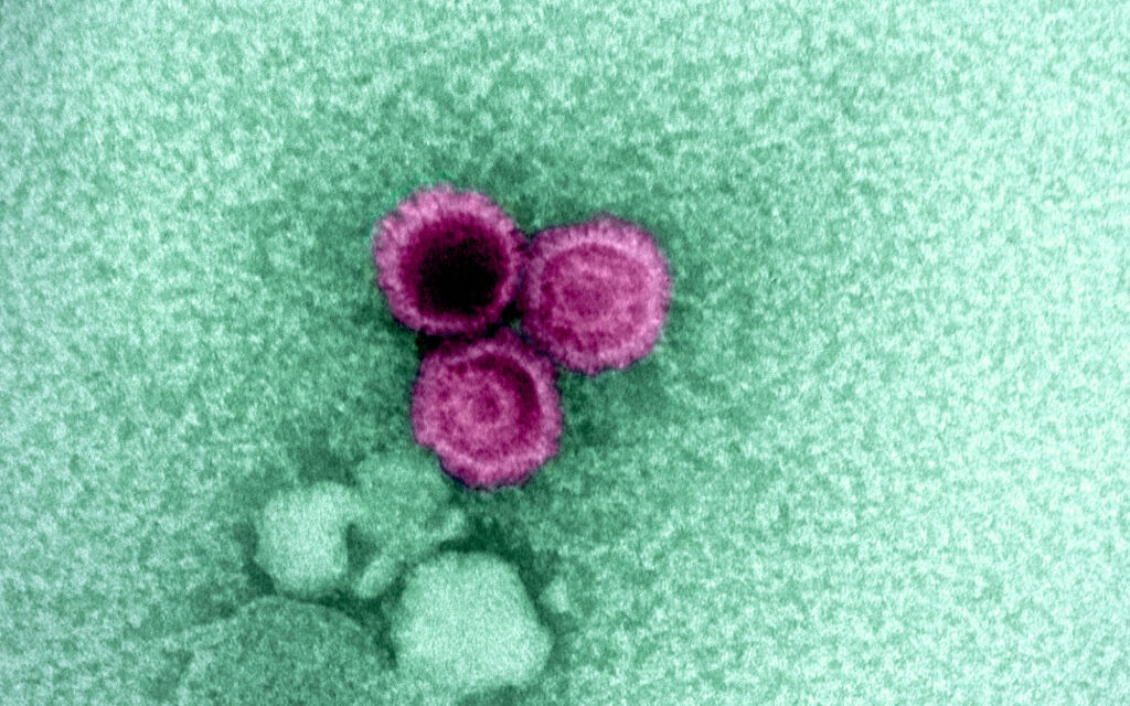 Epstein-Barr virus reactivation precedes MS relapse: what the new study found