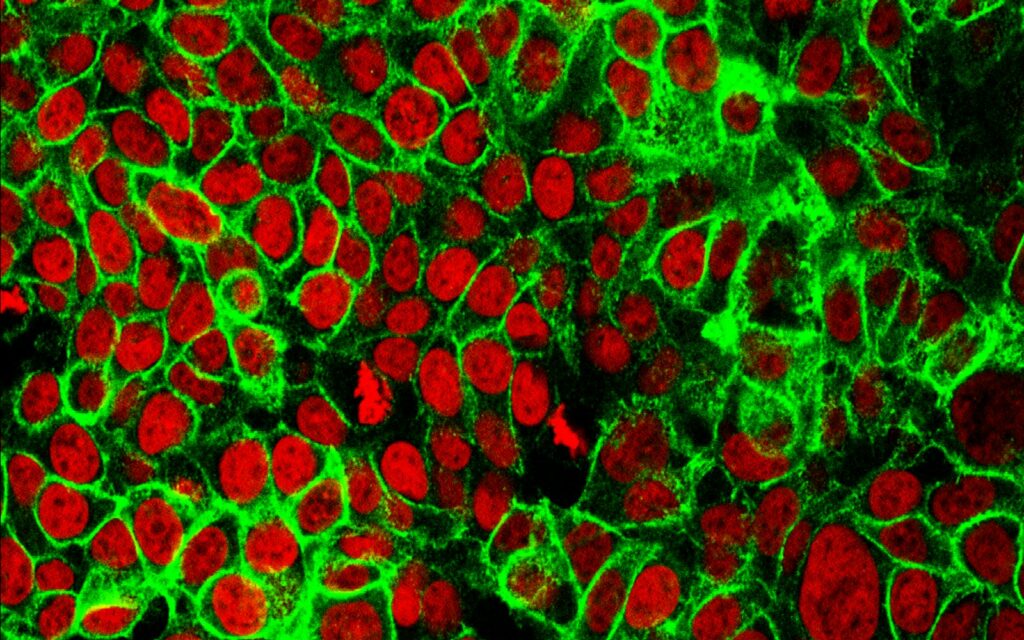 Human colon cancer cells with red-stained nuclei and green E-cadherin under fluorescence microscopy